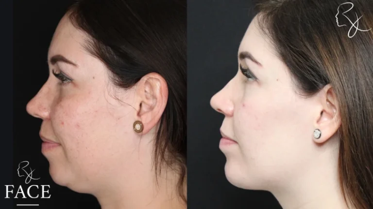 chinAugmentation1-leftProfile