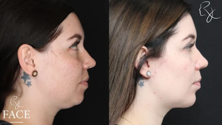 chinAugmentation1-rightProfile