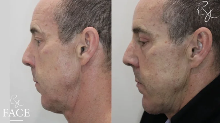 chinAugmentation2-leftProfile