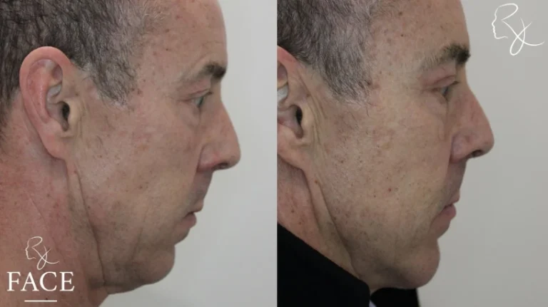 chinAugmentation2-rightProfile