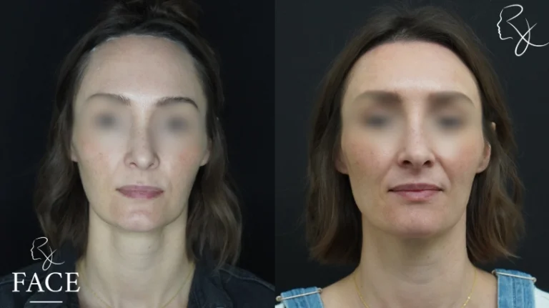 hairlineLowering1-forward