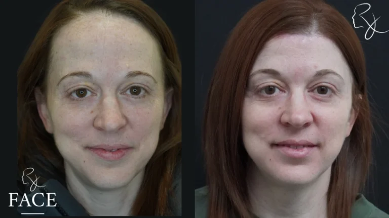 hairlineLowering2-forward