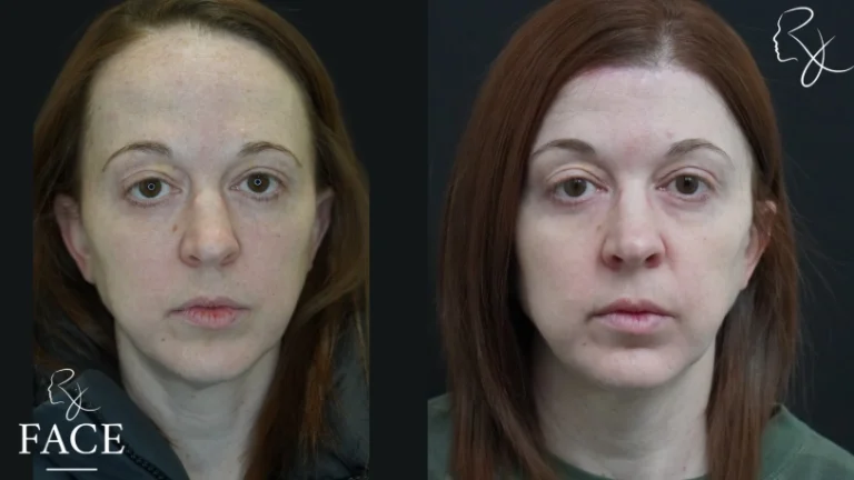 hairlineLowering2-forward2