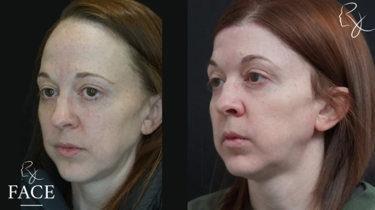 hairlineLowering2-left