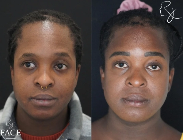 hairlineLowering4-forward