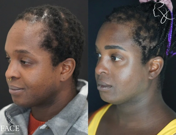 hairlineLowering4-left