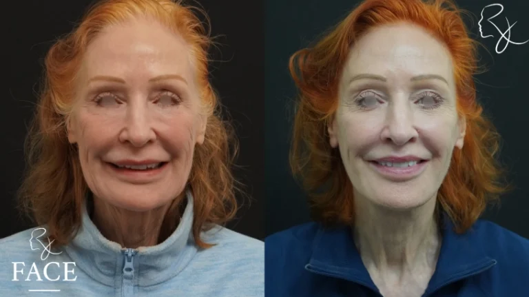 lipLift1-forwardSmiling