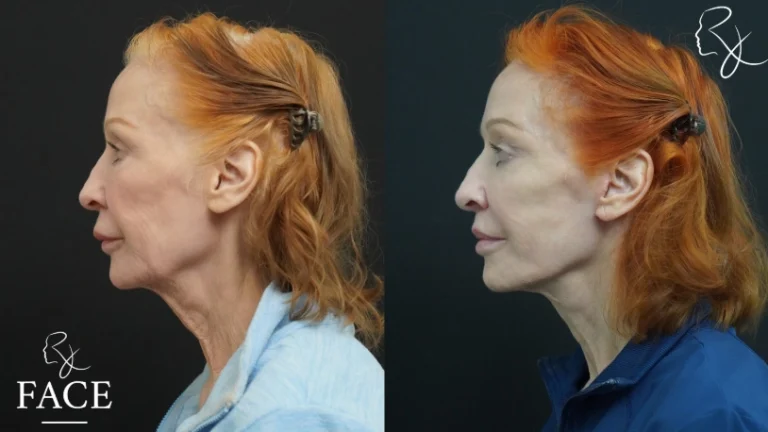 lipLift1-leftProfile