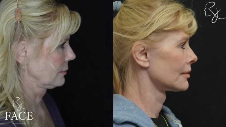 lipLift2-rightProfile