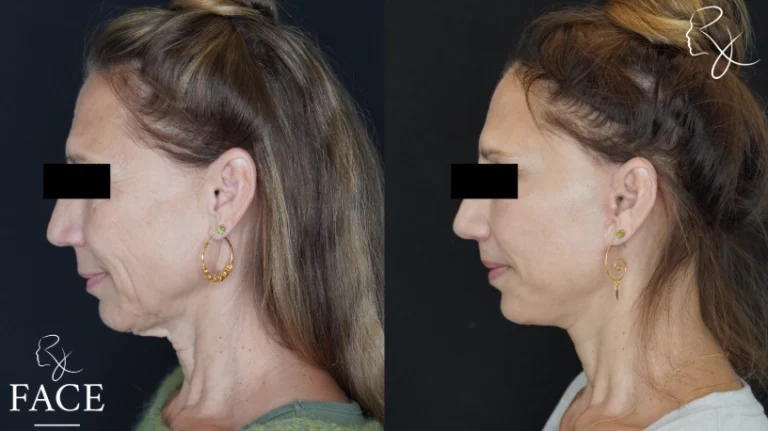 lipLift3-leftProfile