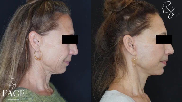 lipLift3-rightProfile