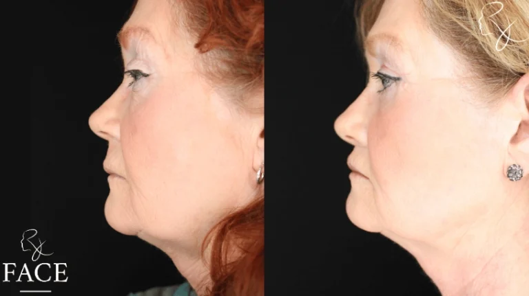 lipLift5-leftProfile