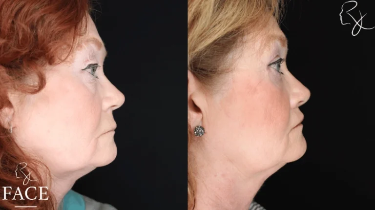 lipLift5-rightProfile