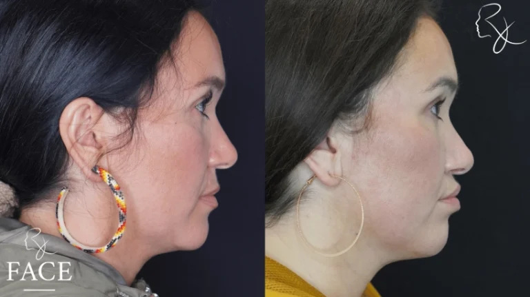 lipLift6-rightProfile