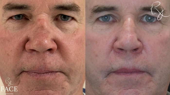 maleRhinoplasty2-forward