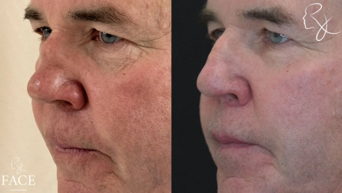 maleRhinoplasty2-left