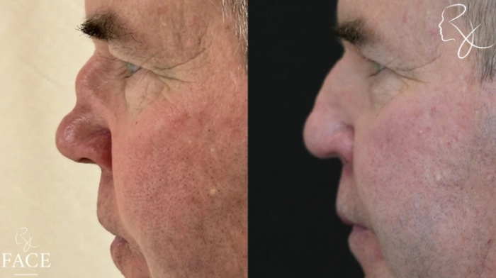 maleRhinoplasty2-leftProfile