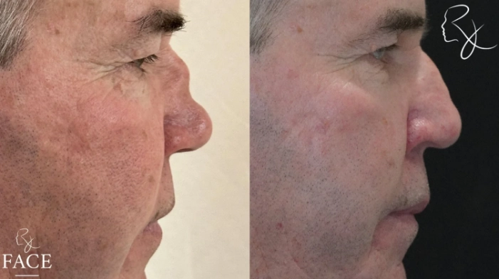 maleRhinoplasty2-rightProfile
