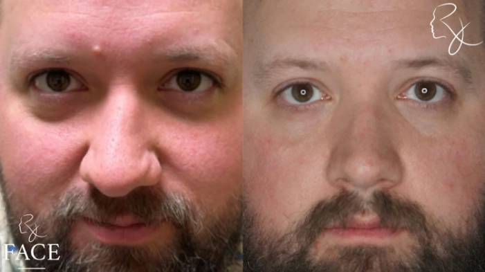 maleRhinoplasty3-forward