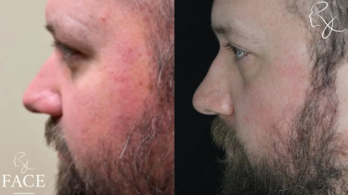 maleRhinoplasty3-leftProfile