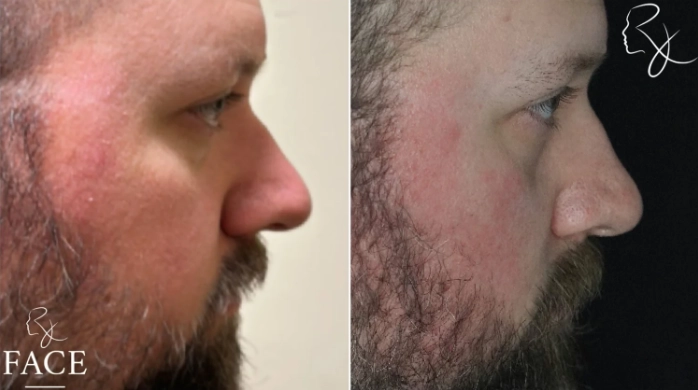 maleRhinoplasty3-rightProfile