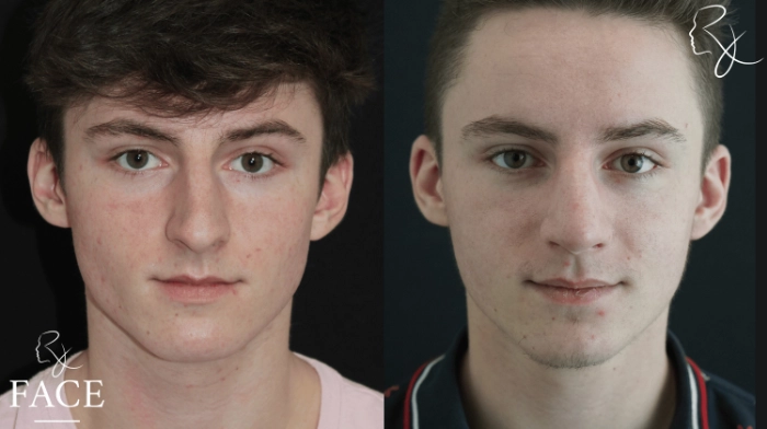 maleRhinoplasty4-forward