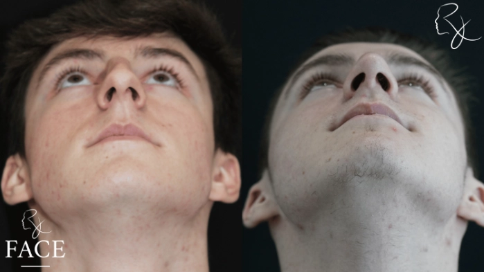maleRhinoplasty4-forwardUp