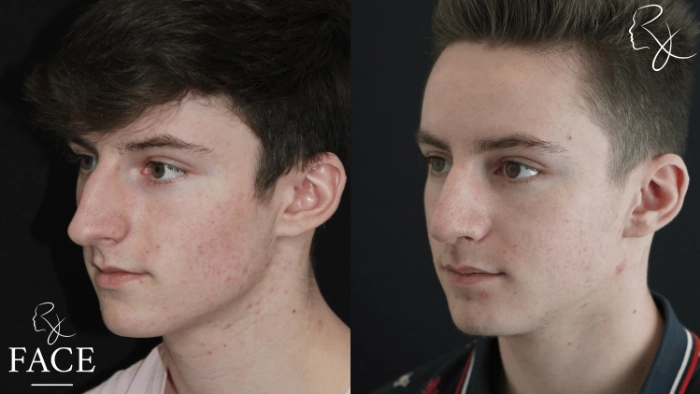 maleRhinoplasty4-left