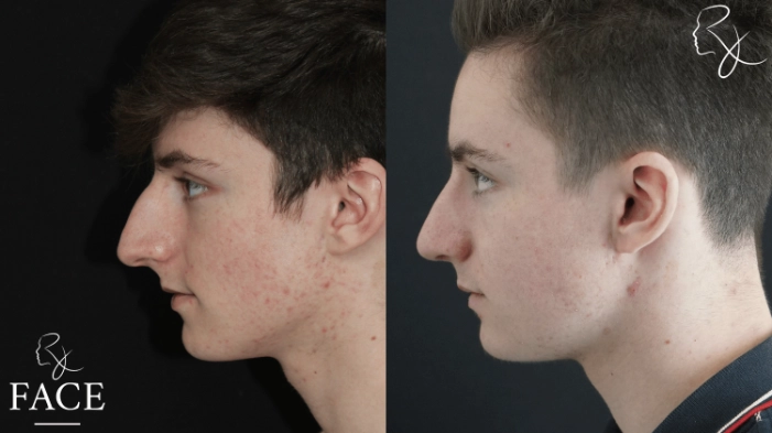 maleRhinoplasty4-leftProfile