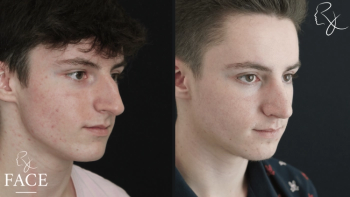 maleRhinoplasty4-right