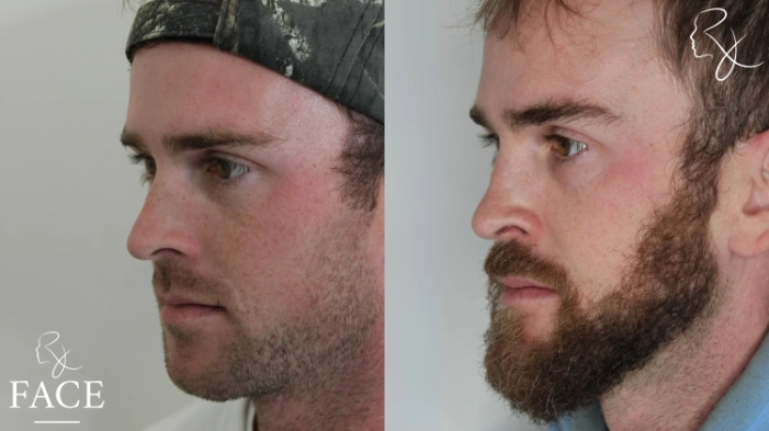 maleRhinoplasty5-left