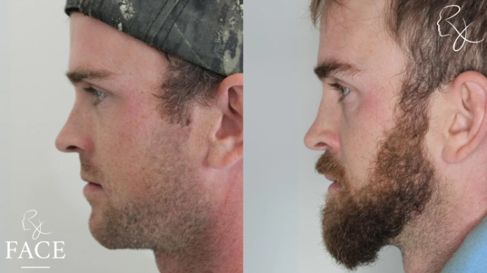 maleRhinoplasty5-leftProfile