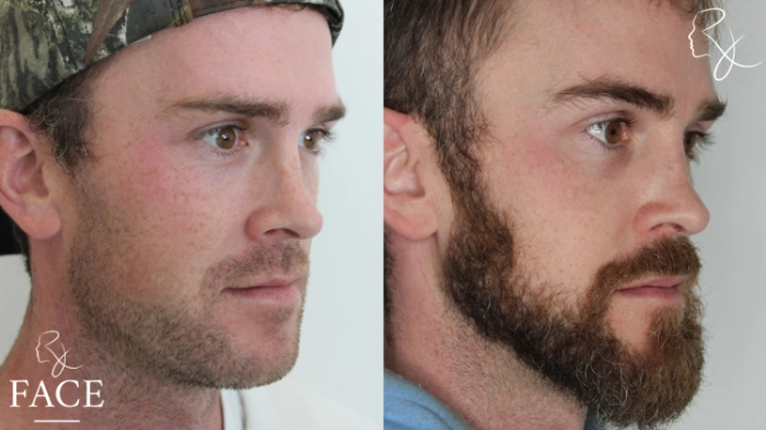maleRhinoplasty5-right