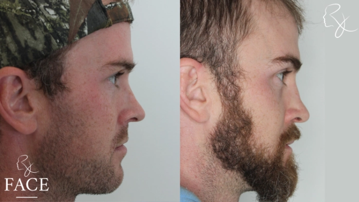 maleRhinoplasty5-rightProfile