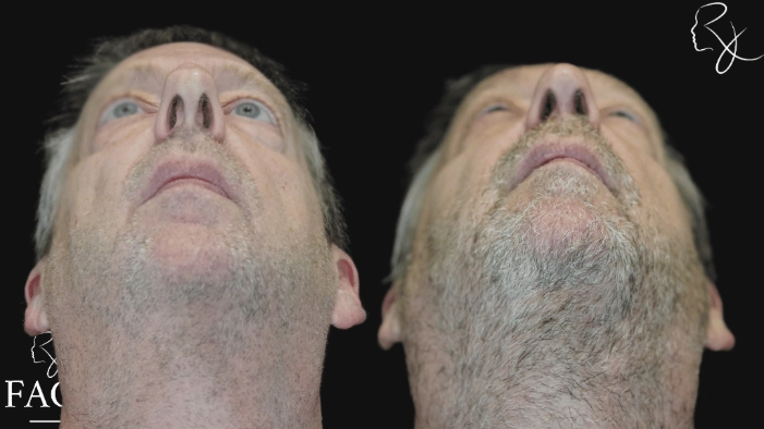 maleRhinoplasty6-forwardUp
