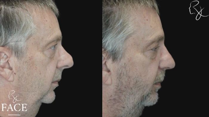 maleRhinoplasty6-rightProfile