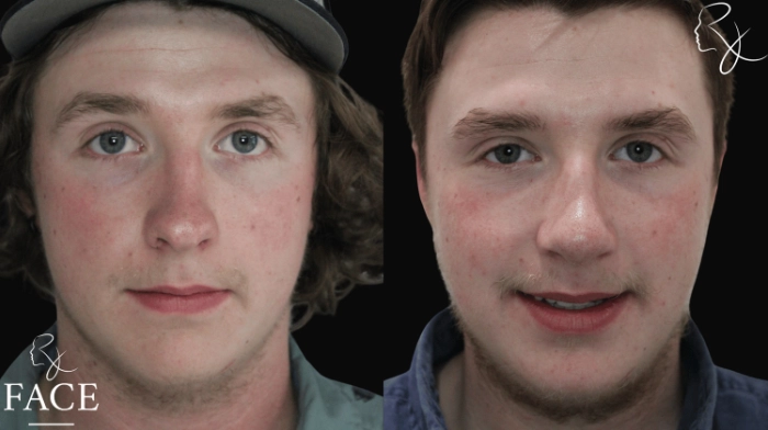 maleRhinoplasty7-forward