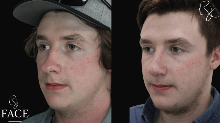 maleRhinoplasty7-left