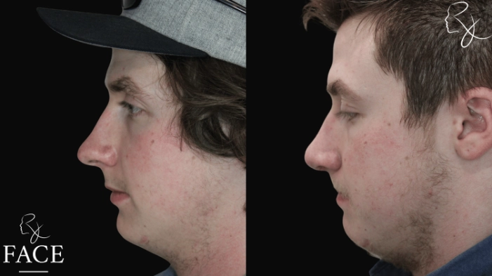 maleRhinoplasty7-leftProfile