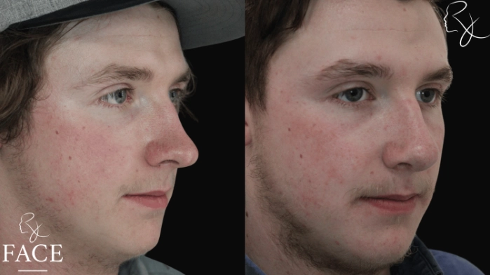 maleRhinoplasty7-right