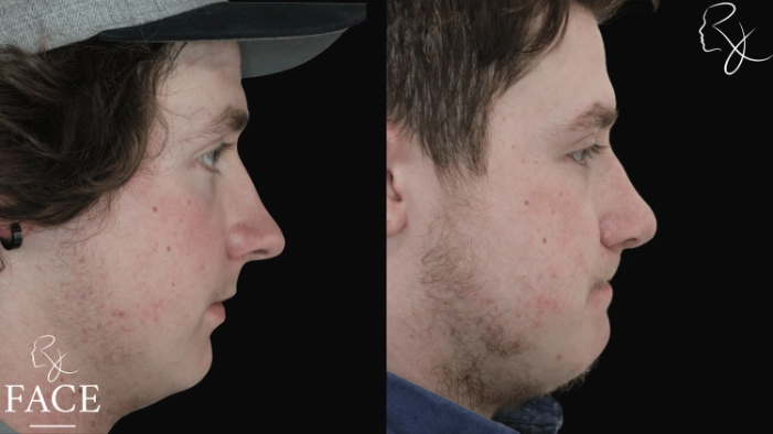 maleRhinoplasty7-rightProfile