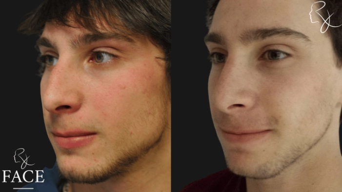 maleRhinoplasty8-left