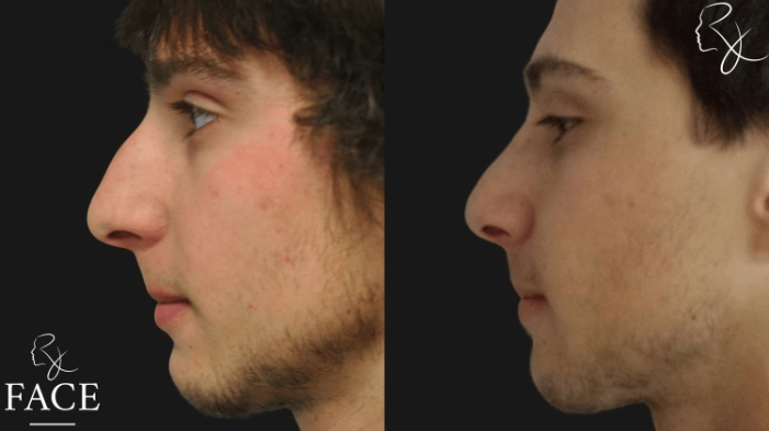 maleRhinoplasty8-leftProfile