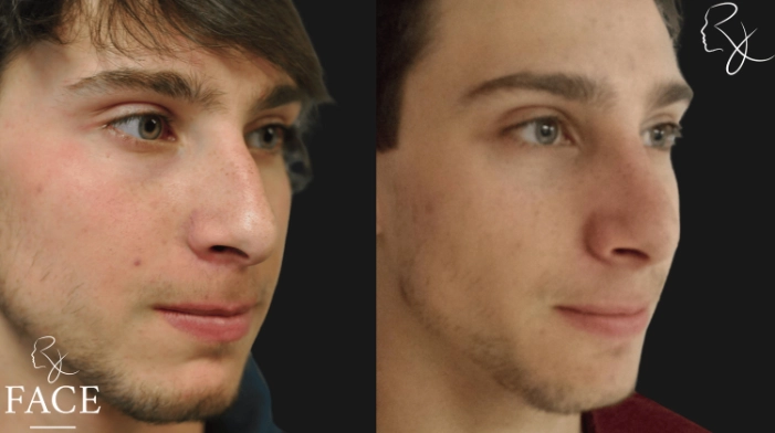 maleRhinoplasty8-right