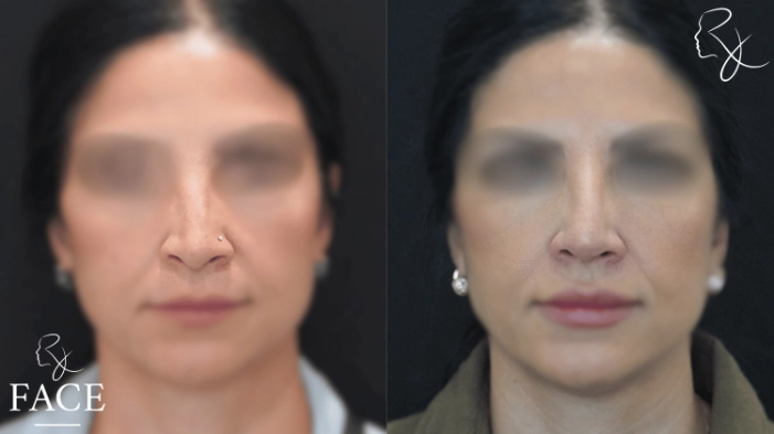 rivisionRhinoplasty1-forward