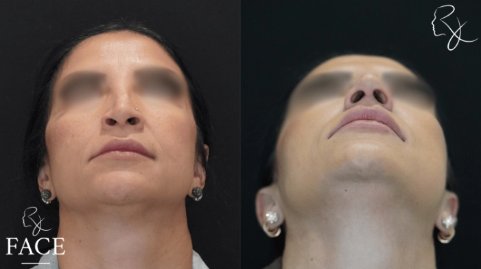 rivisionRhinoplasty1-forwardUp