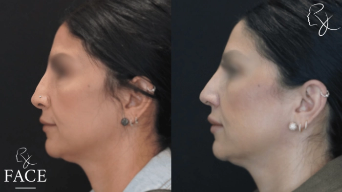 rivisionRhinoplasty1-leftProfile