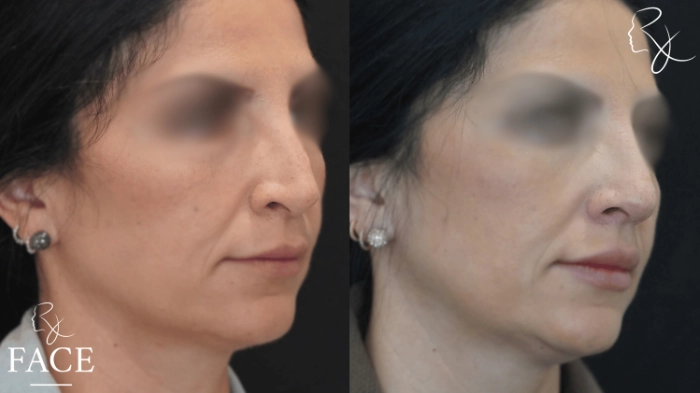 rivisionRhinoplasty1-right