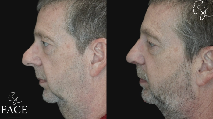 rivisionRhinoplasty2-leftProfile