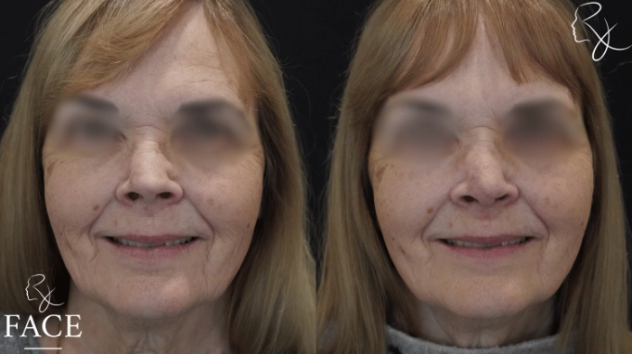 rivisionRhinoplasty3-forward